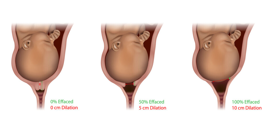 Cervical Effacement and Dilation During Delivery